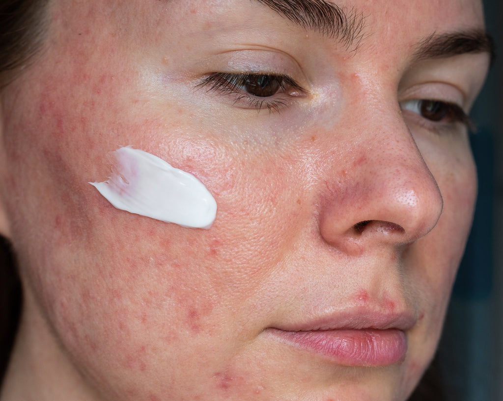 Accutane for Skin: A Comprehensive Guide to Safety and Efficacy