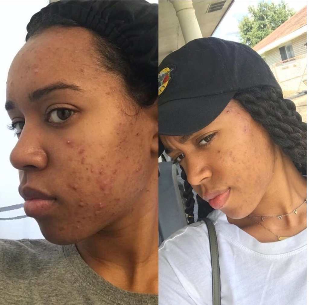 Acne Kit 2-Part System for Clear, Healthy Skin | Three Notes – Three ...